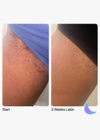 Topicals High Roller Ingrown Tonic with AHAs + BHAs image 1