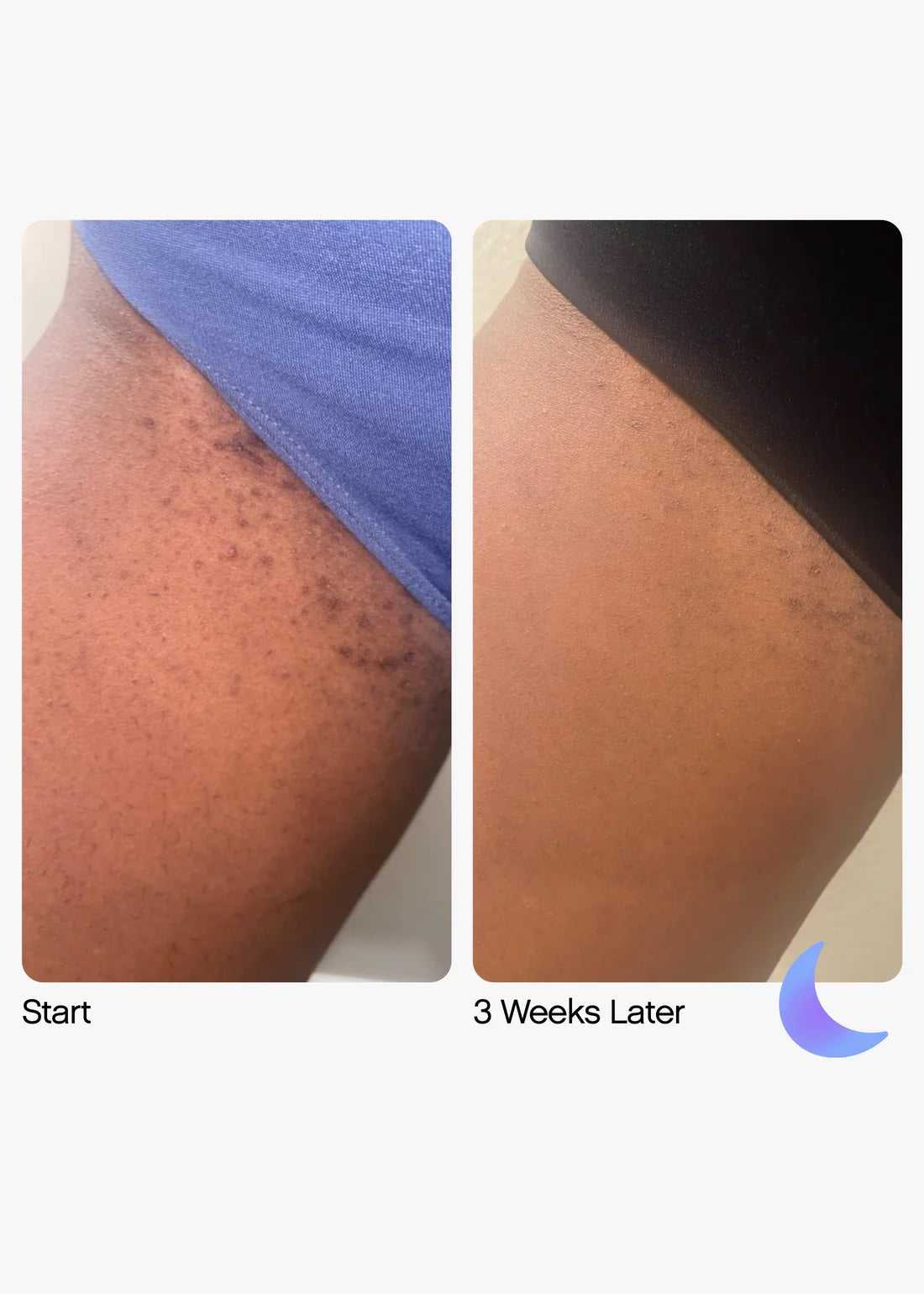 Topicals High Roller Ingrown Tonic with AHAs + BHAs image 1